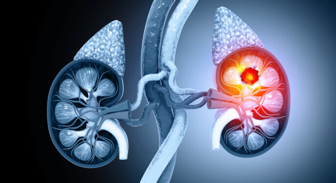 Cancerous Tumor Inside The Kidney