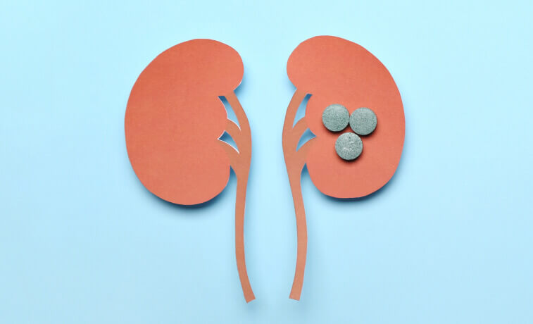 Kidney Stones Paper Cut