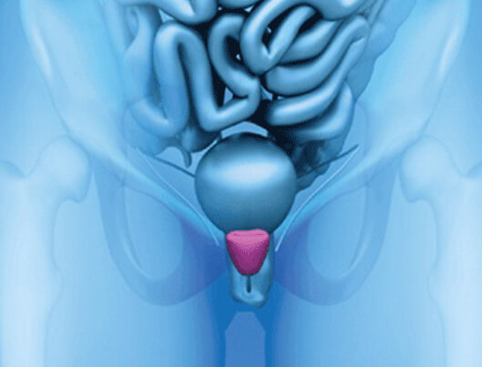 Prostate Cancer